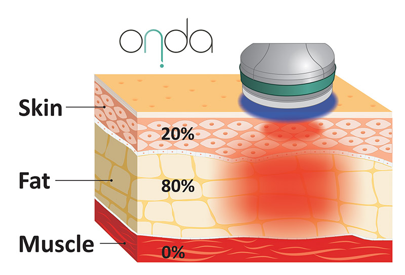 Onda-Coolwaves-treatments-medicine-aesthetics-dermatology