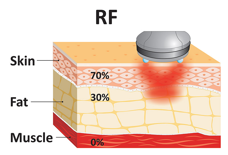 radiofrequency-or-microwaves-patent-Onda-Coolwaves